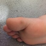 足のイボ治療：次男(平成31年2月)