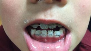 歯の矯正4月：次男